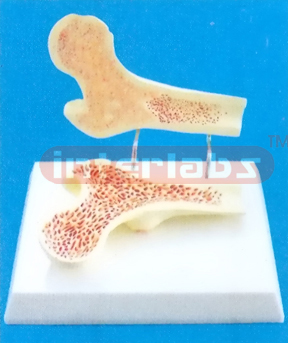 MIDDLE FEMUR BONE TWINS (FEMORAL HEAD SECTION SHOWING OSTEOPOROSIS